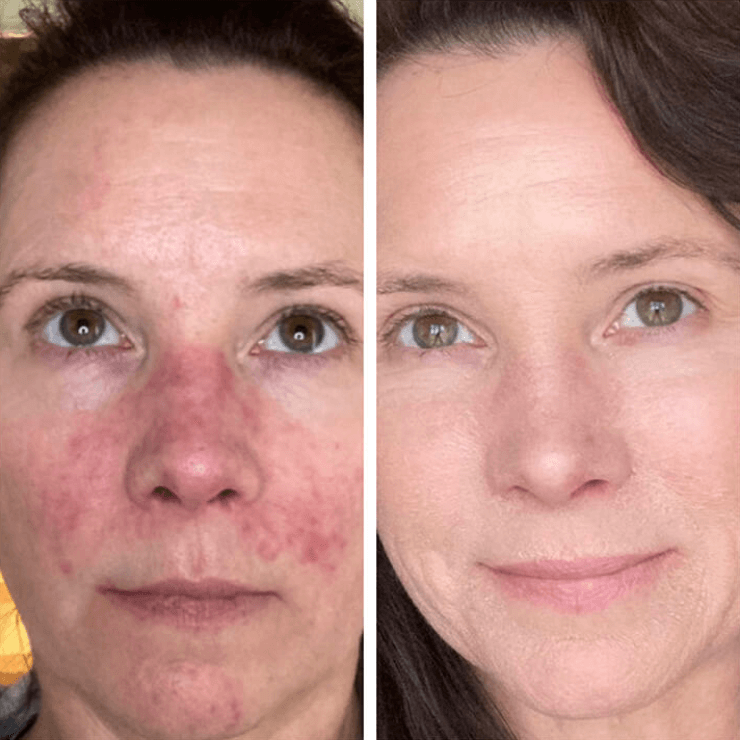 ROSACEA GRADE 2