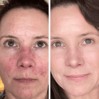 ROSACEA GRADE 2