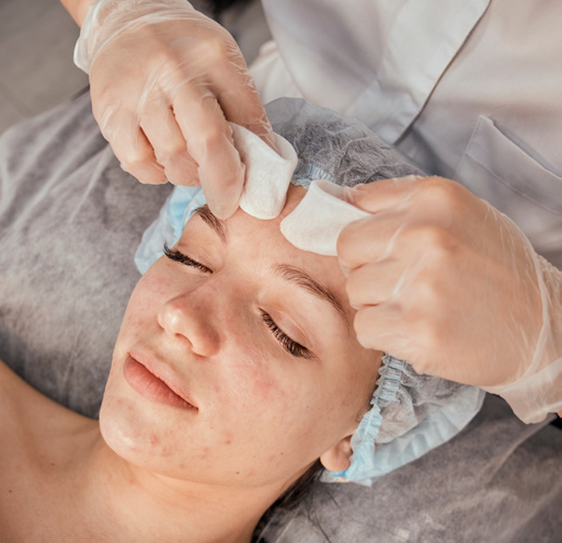 Complex Treatment medium-depth chemical peel targeting acne, discoloration and uneven texture