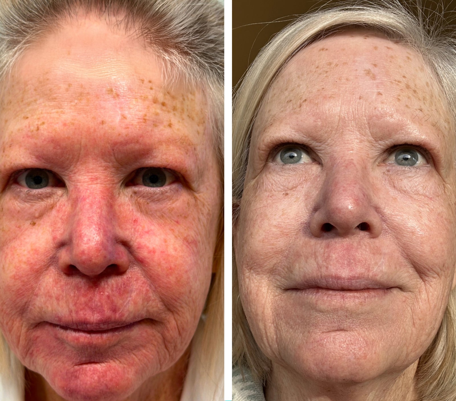 ROSACEA GRADE 3