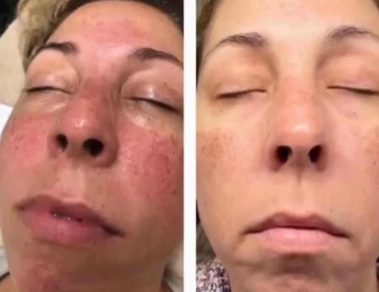 ROSACEA GRADE 3